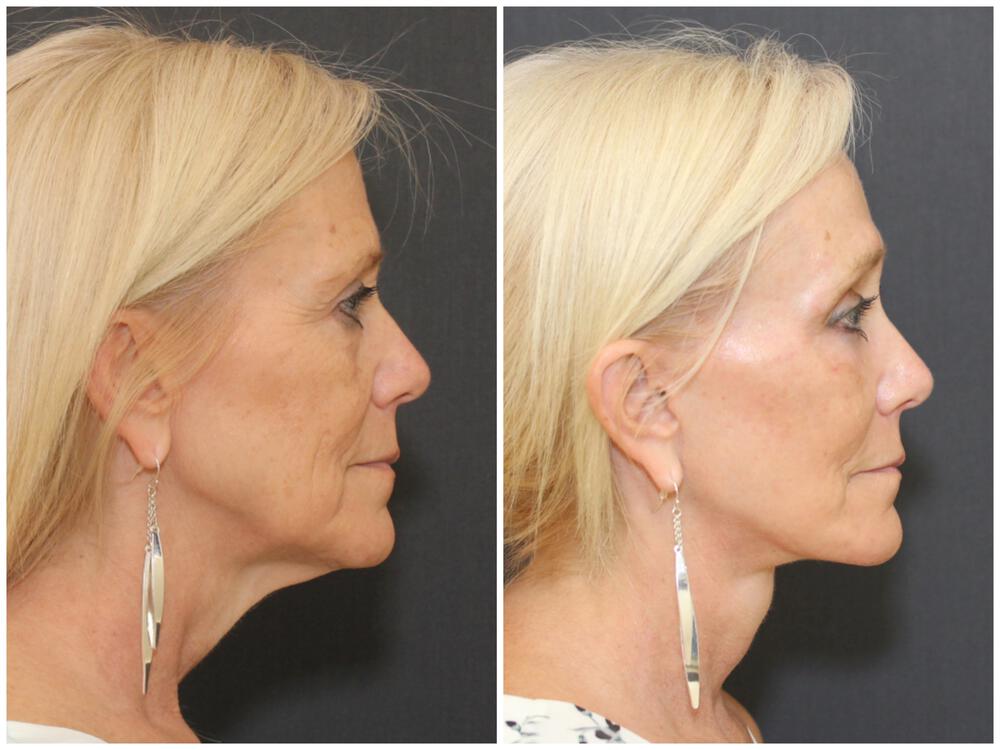 Deep Necklift Before & After Image