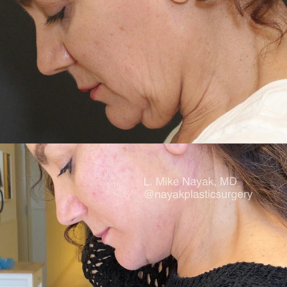 Deep Necklift Before & After Image