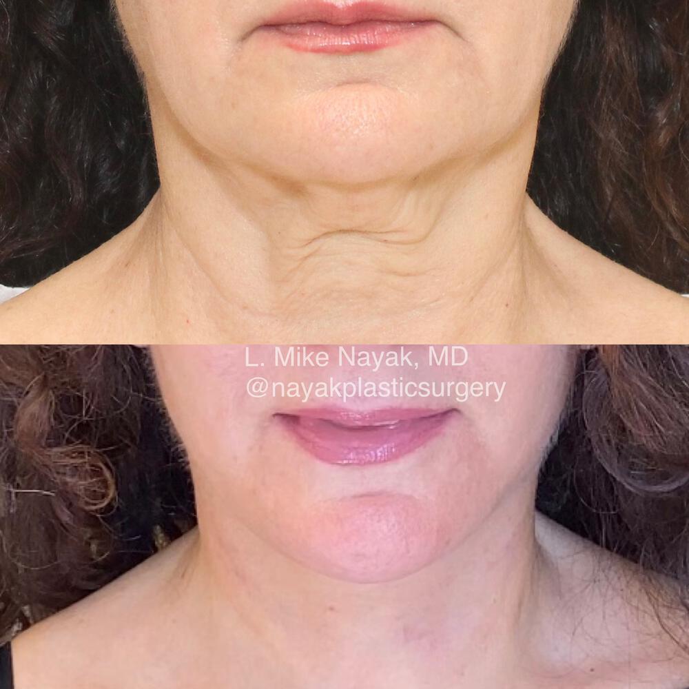 Deep Necklift Before & After Image