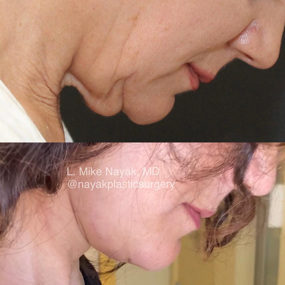 Deep Necklift Before & After Image