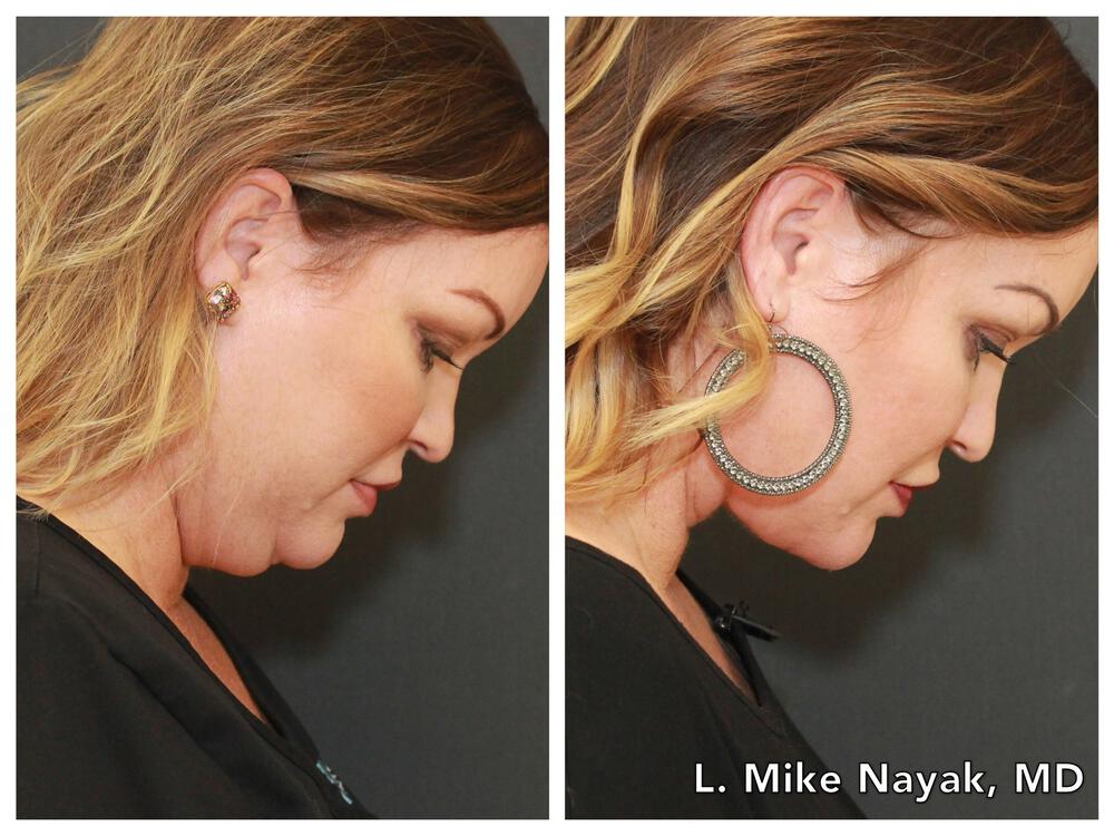 Deep Necklift Before & After Image