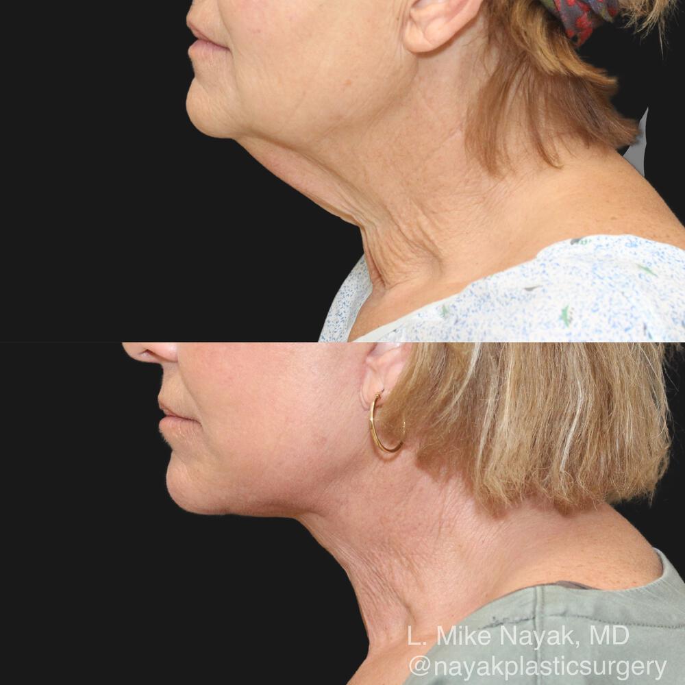 Deep Necklift Before & After Image