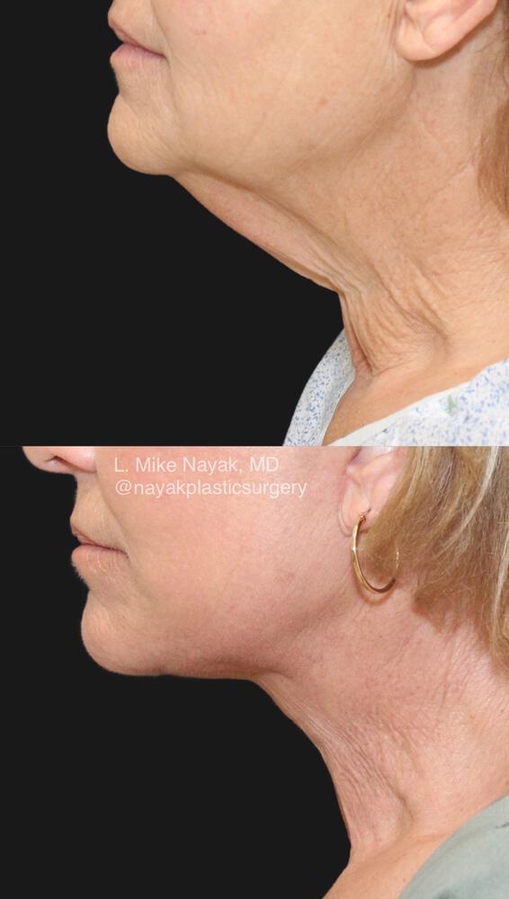 Deep Necklift Before & After Image