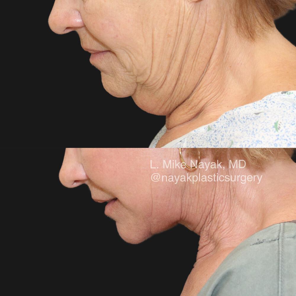 Deep Necklift Before & After Image