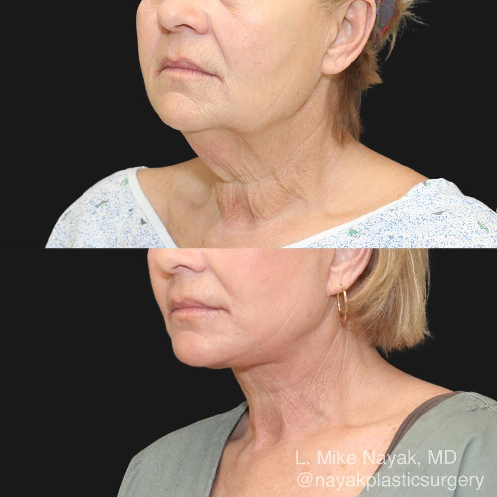 Deep Necklift Before & After Image