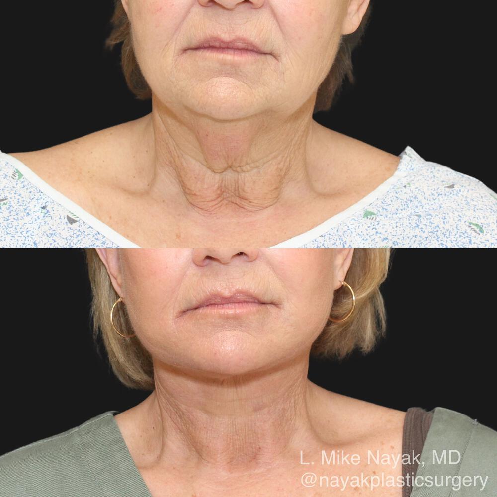 Deep Necklift Before & After Image