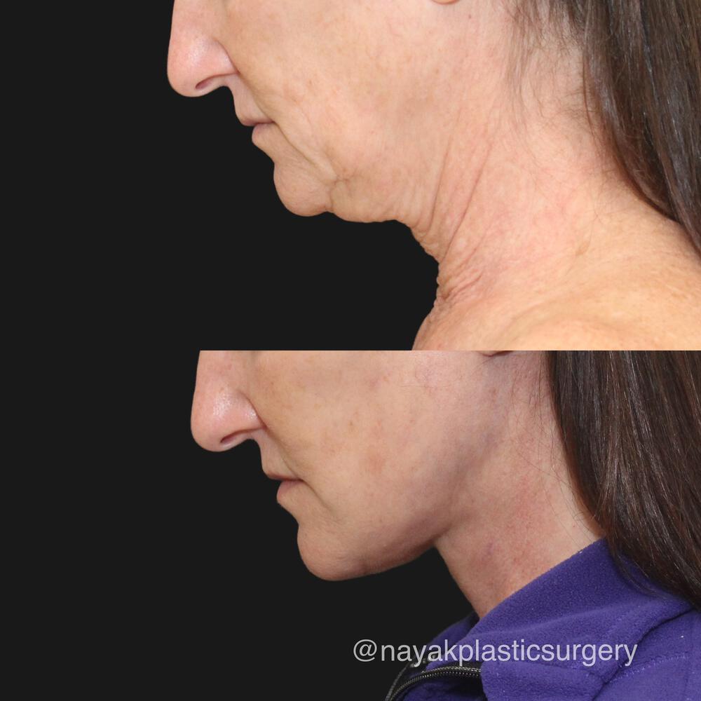 Deep Necklift Before & After Image