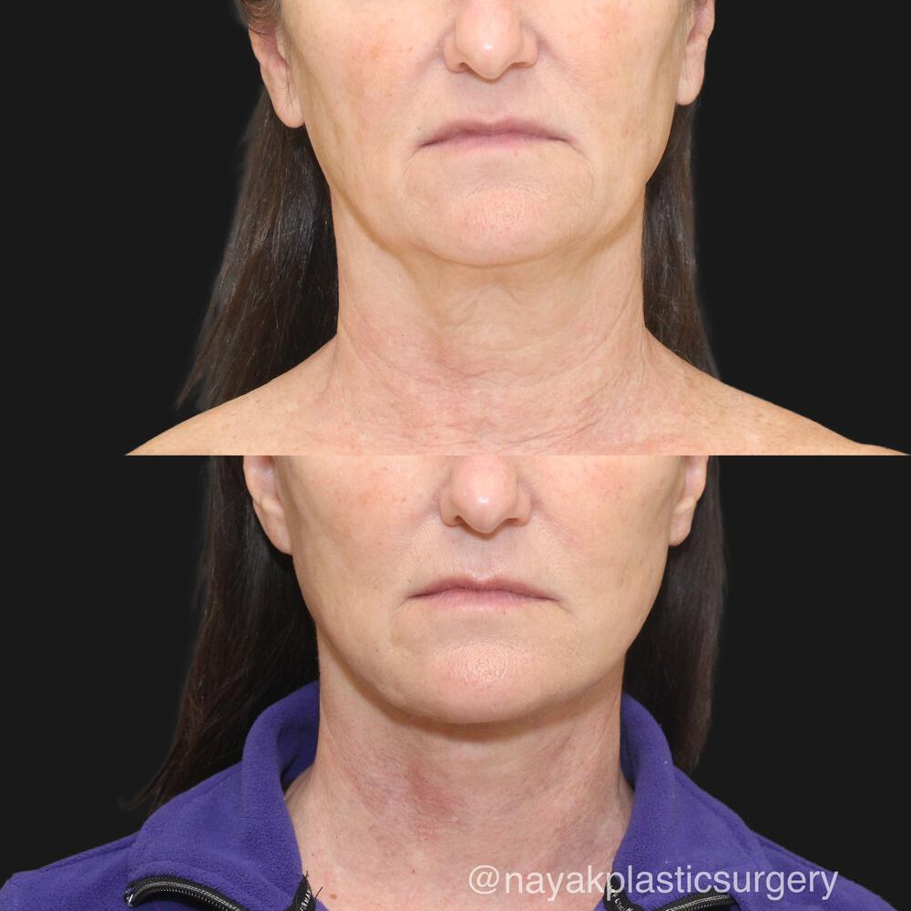 Deep Necklift Before & After Image