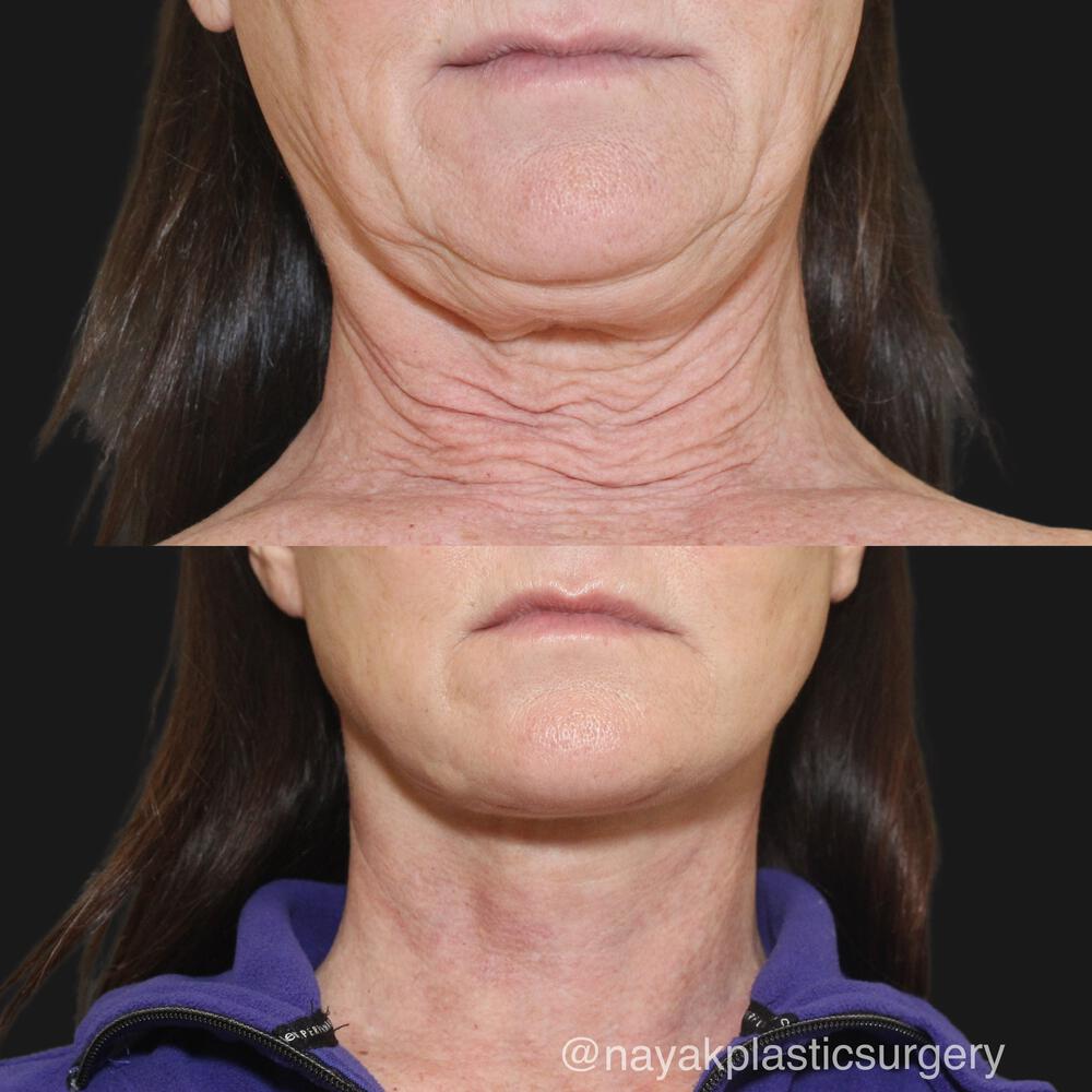 Deep Necklift Before & After Image