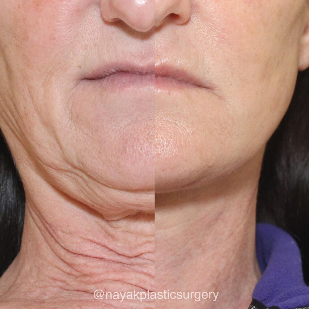 Deep Necklift Before & After Image