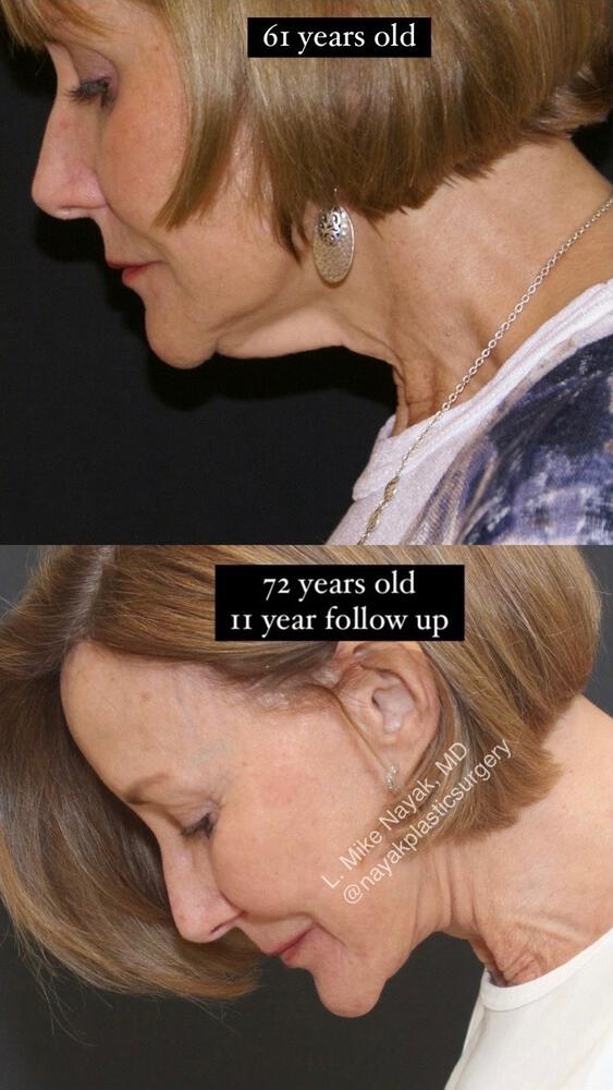 Deep Necklift Before & After Image