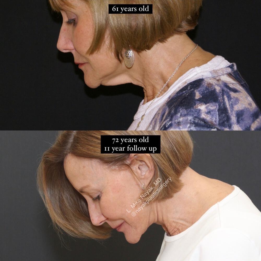 Deep Necklift Before & After Image