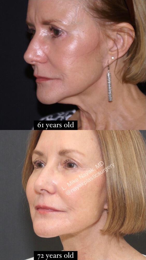 Deep Necklift Before & After Image