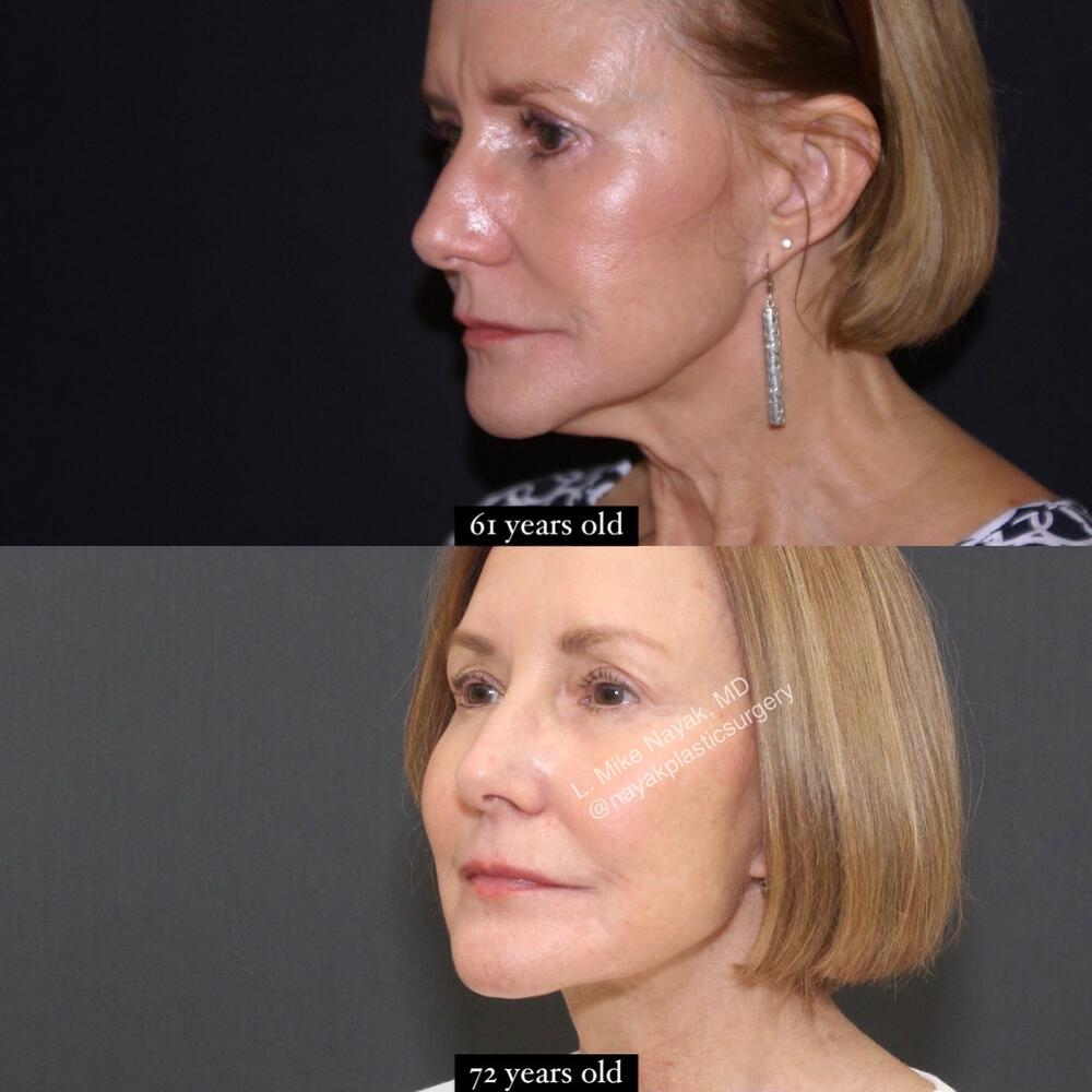 Deep Necklift Before & After Image