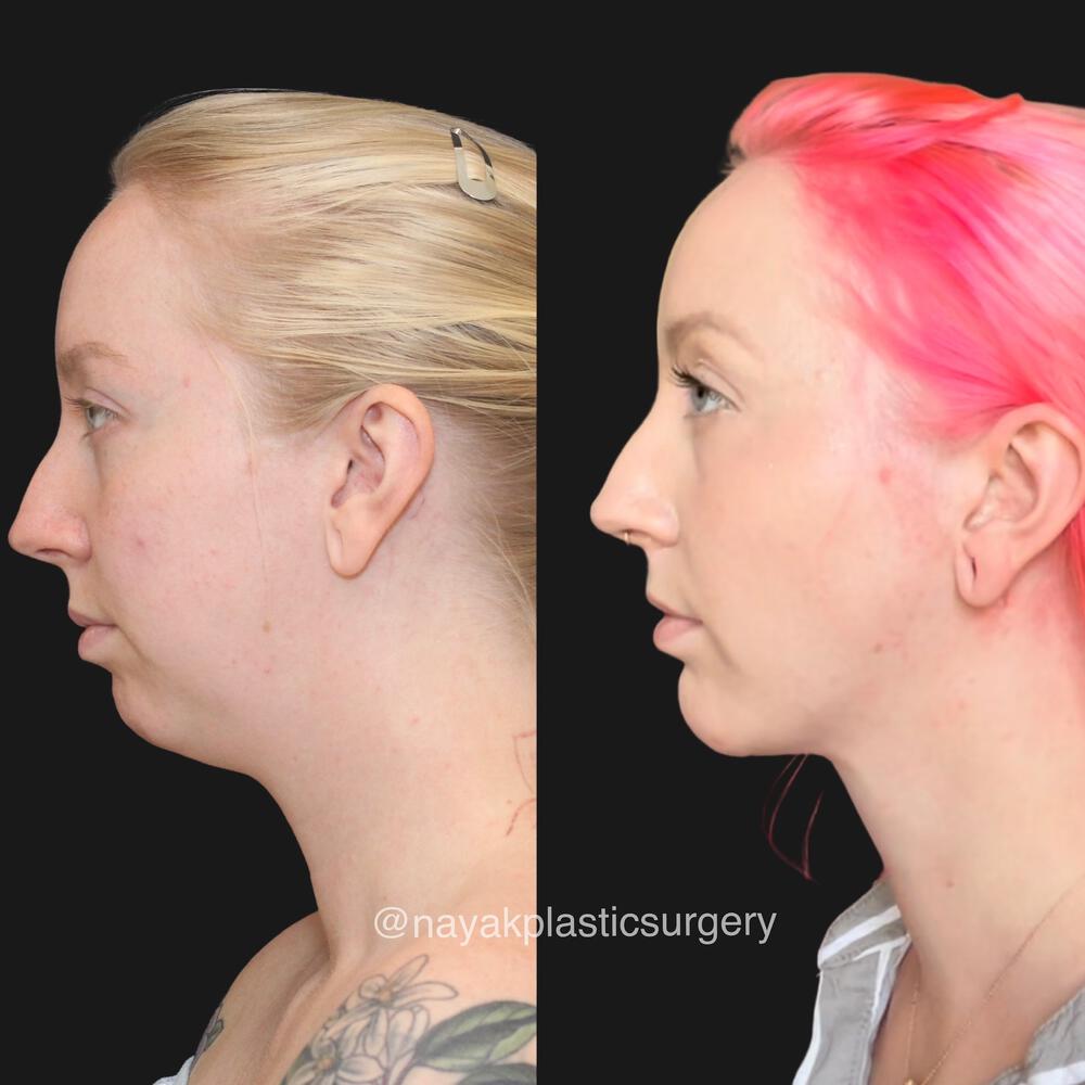 Deep Necklift Before & After Image