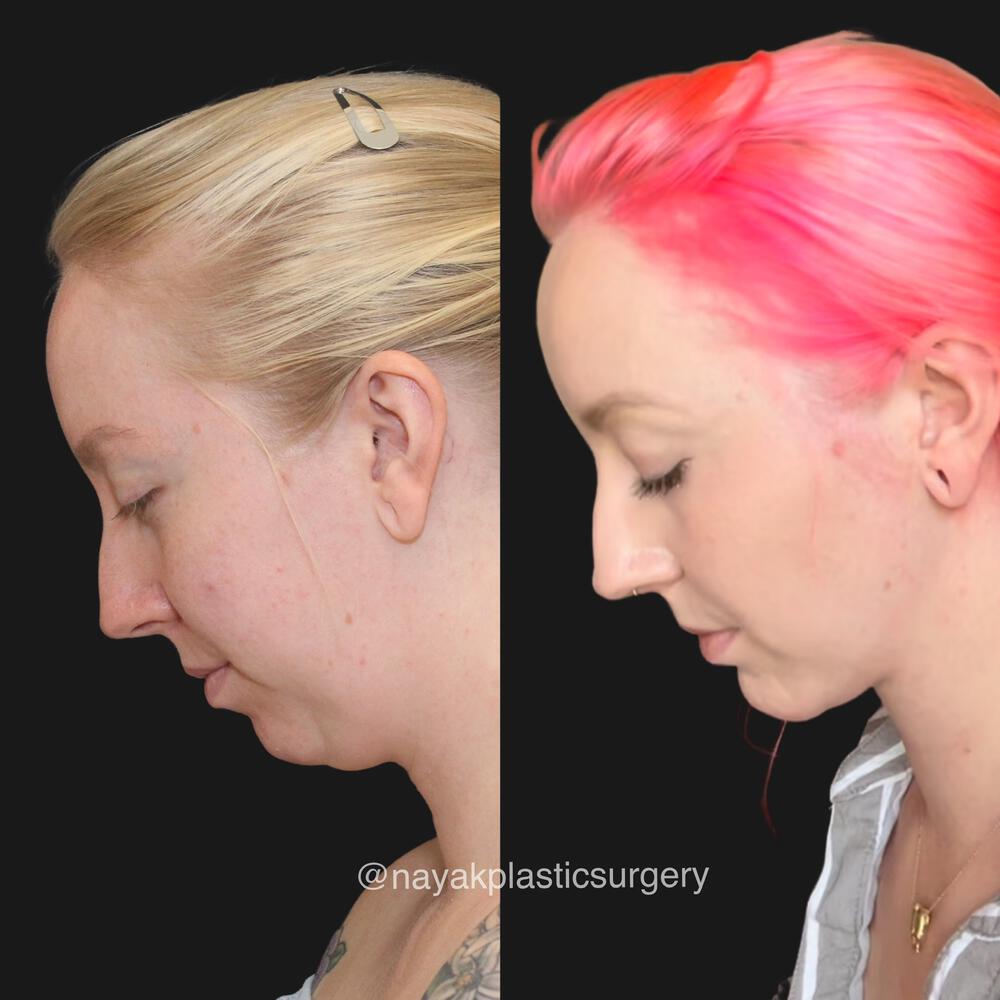 Deep Necklift Before & After Image