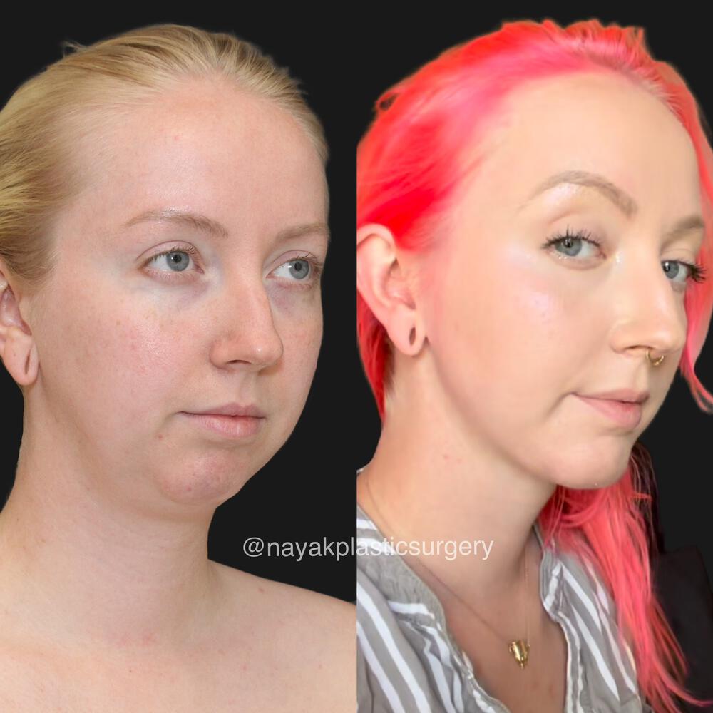 Deep Necklift Before & After Image