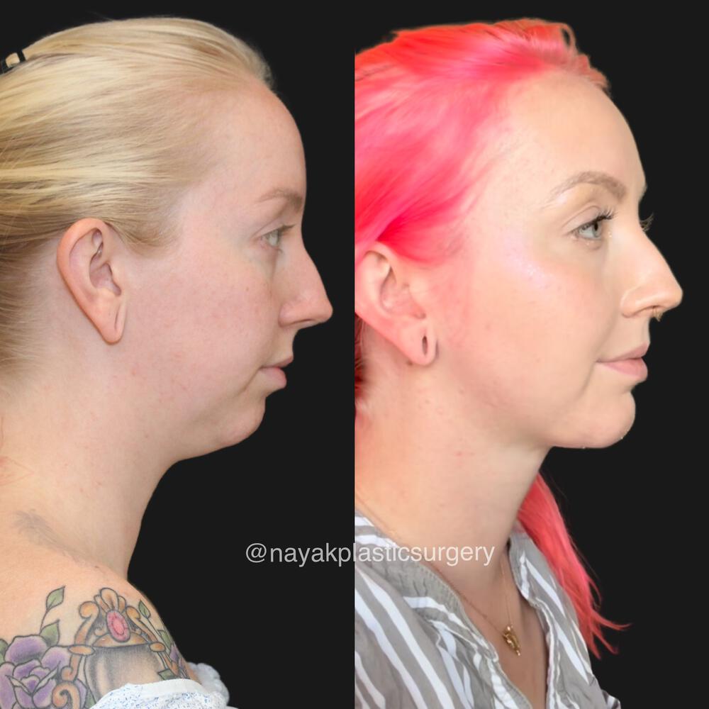 Deep Necklift Before & After Image