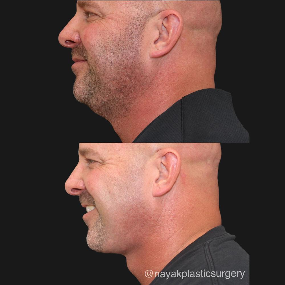 Deep Necklift Before & After Image