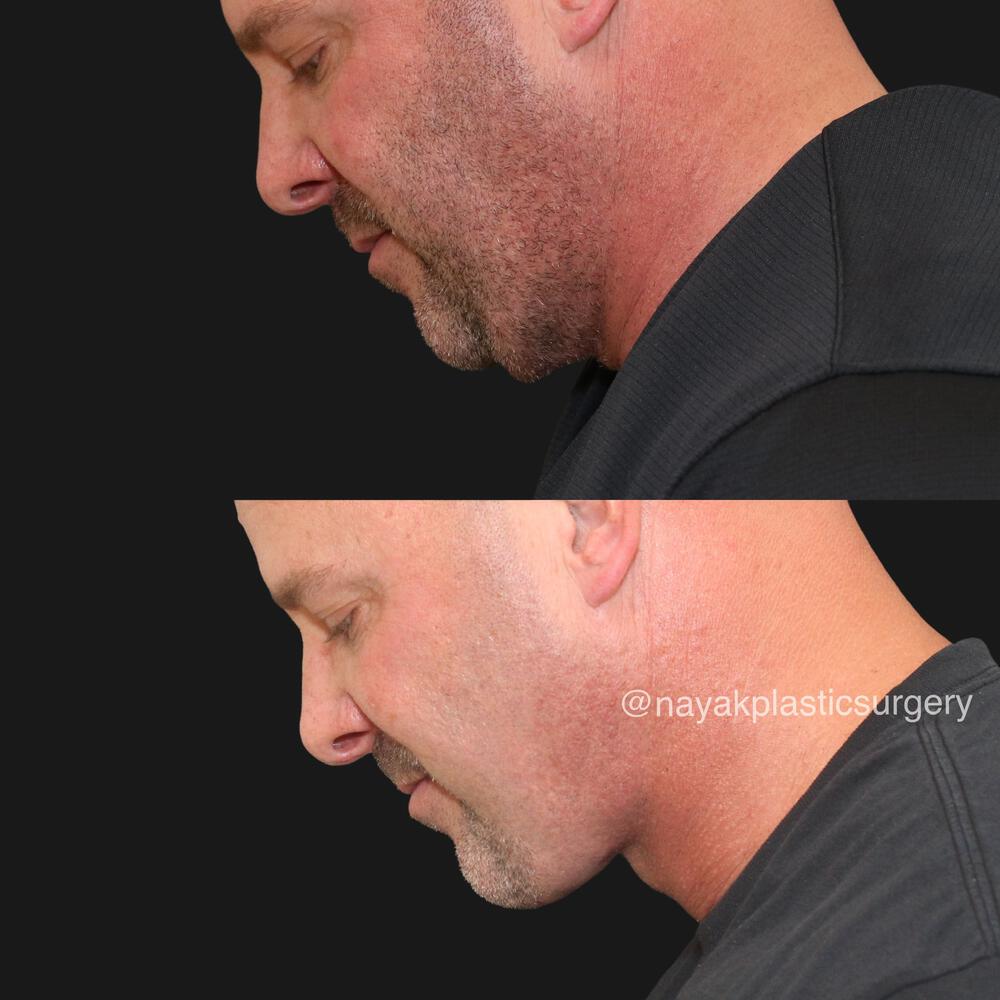 Deep Necklift Before & After Image