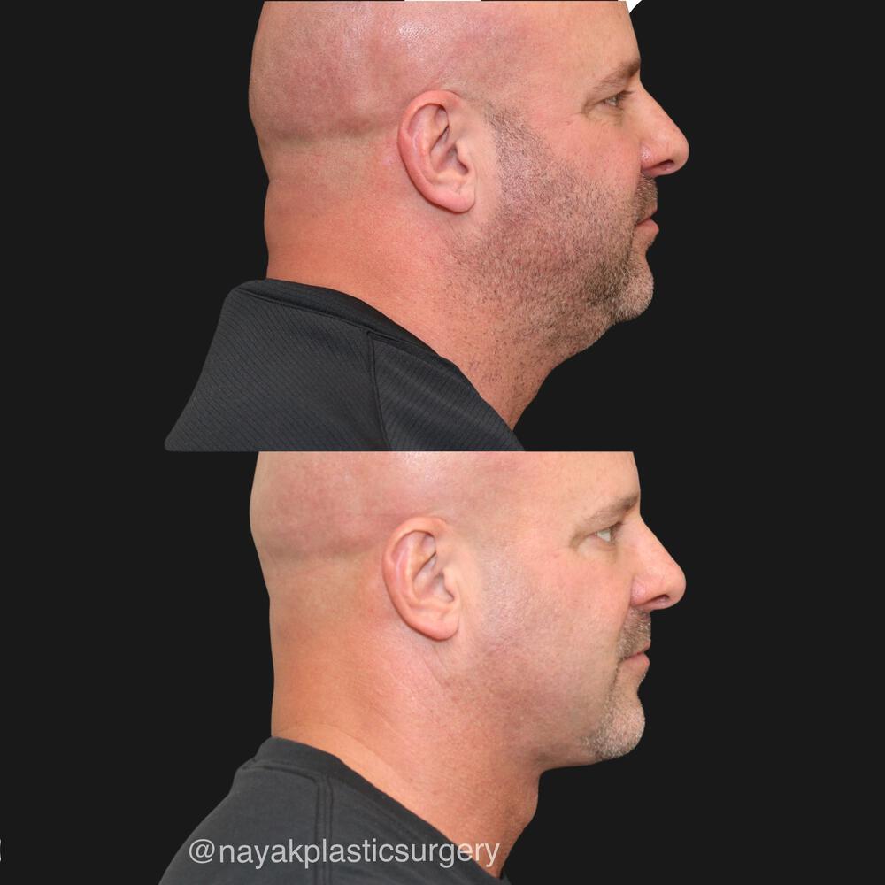 Deep Necklift Before & After Image