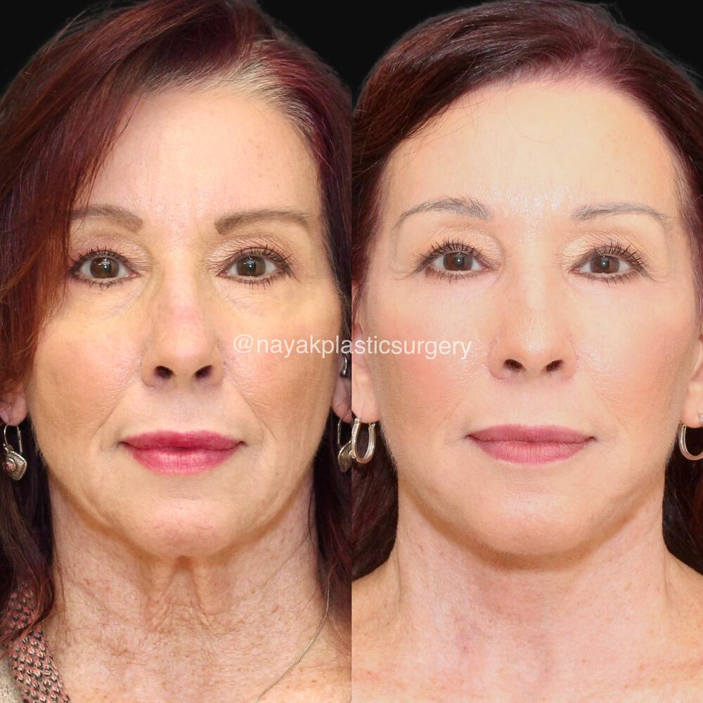 Deep Necklift Before & After Image