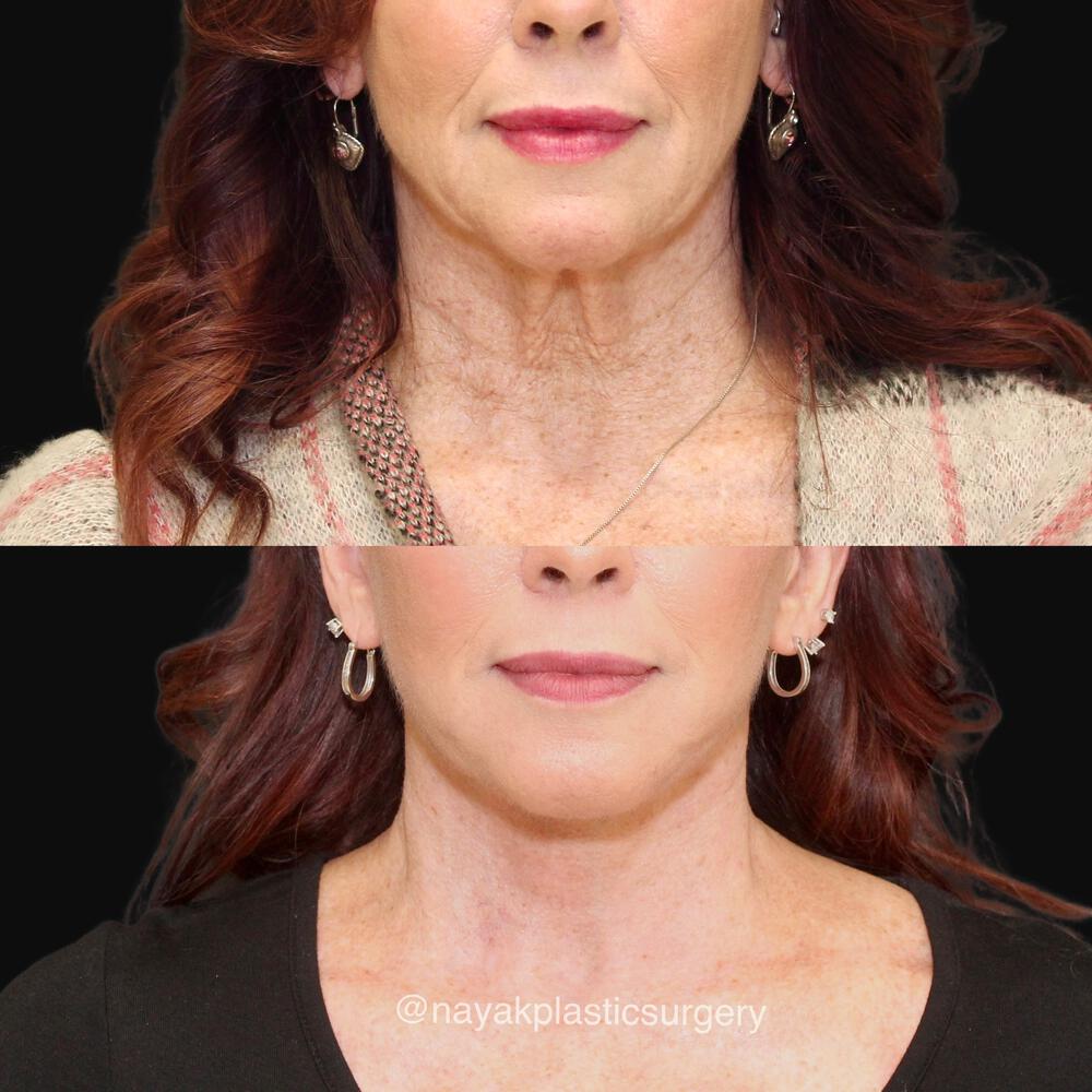 Deep Necklift Before & After Image