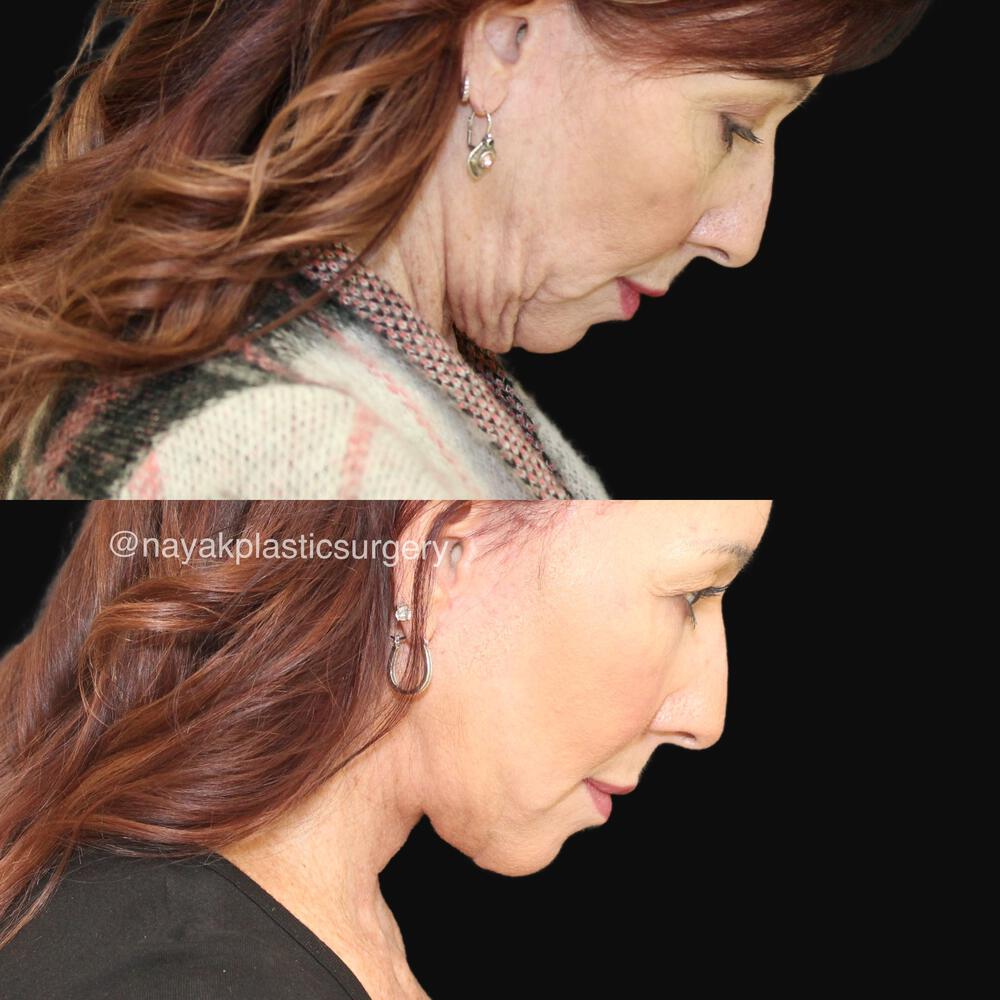 Deep Necklift Before & After Image