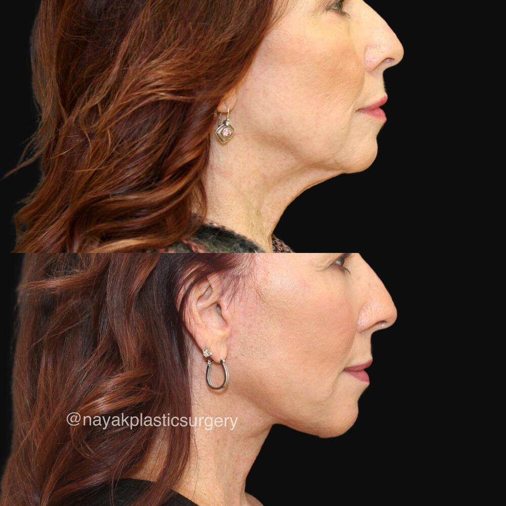 Deep Necklift Before & After Image