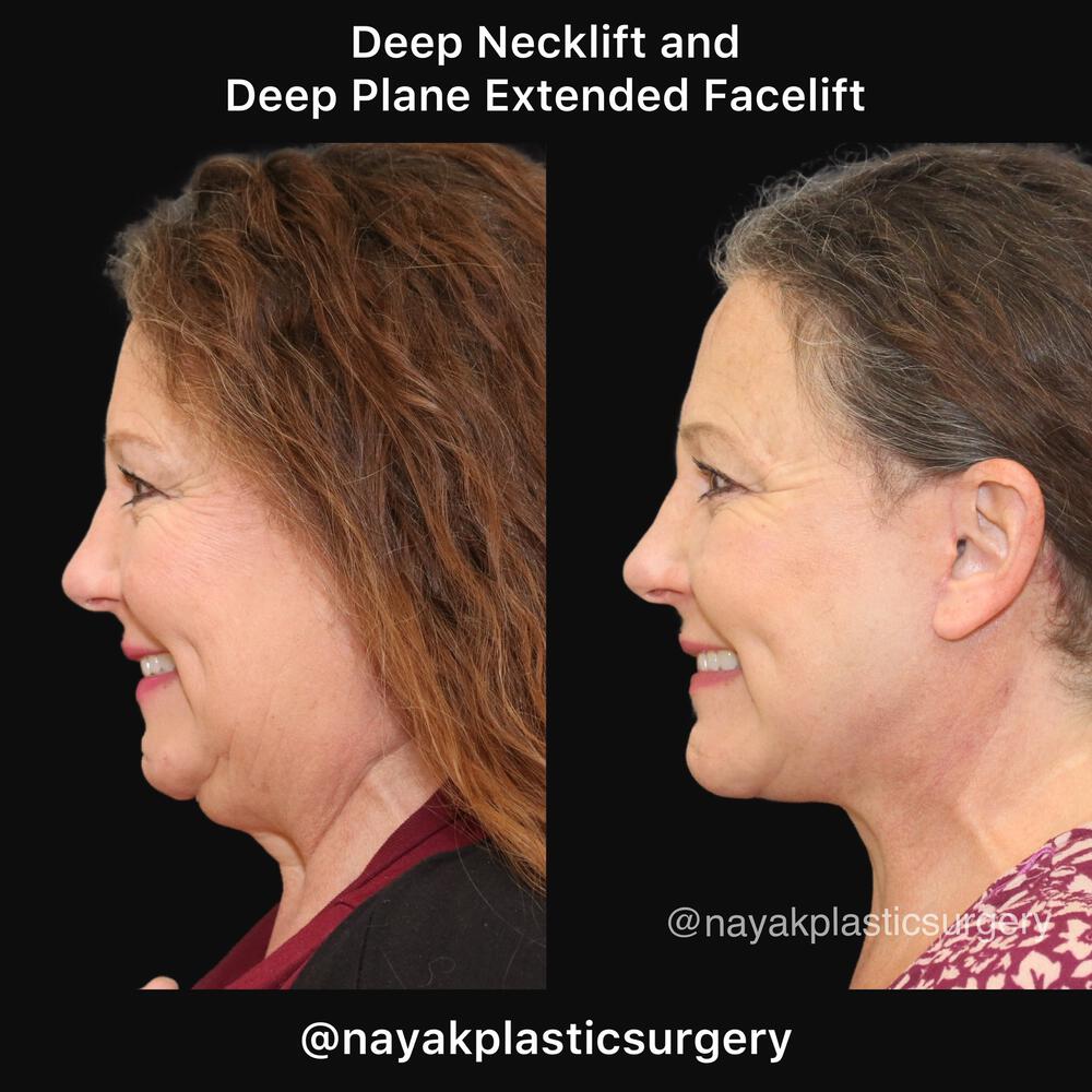 Deep Necklift Before & After Image