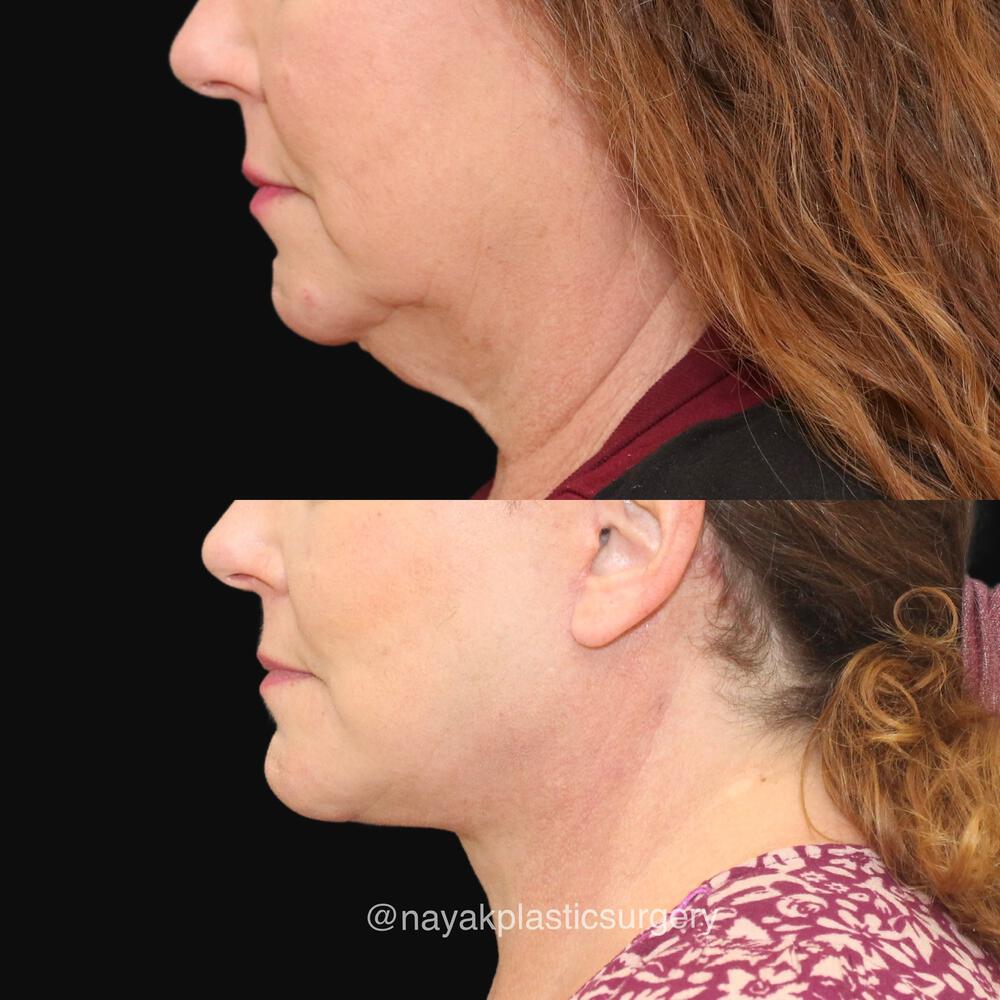 Deep Necklift Before & After Image