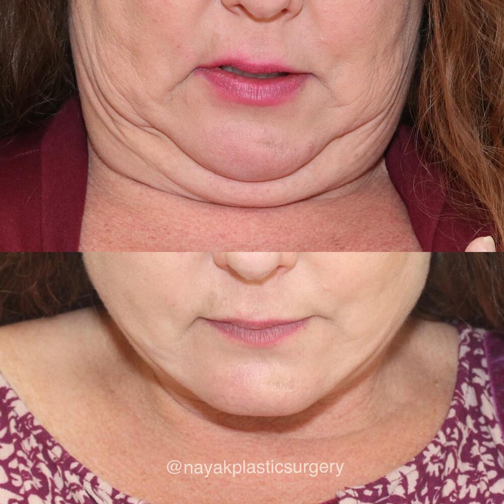 Deep Necklift Before & After Image