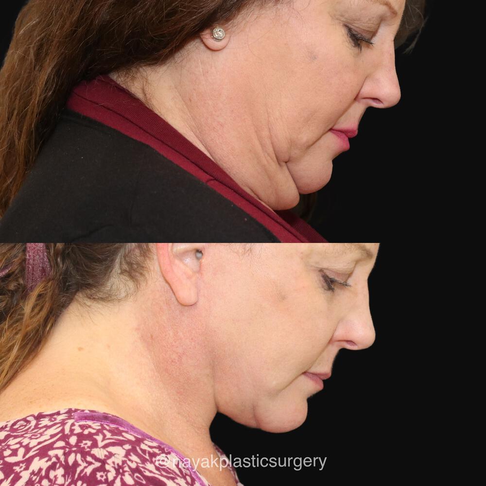 Deep Necklift Before & After Image