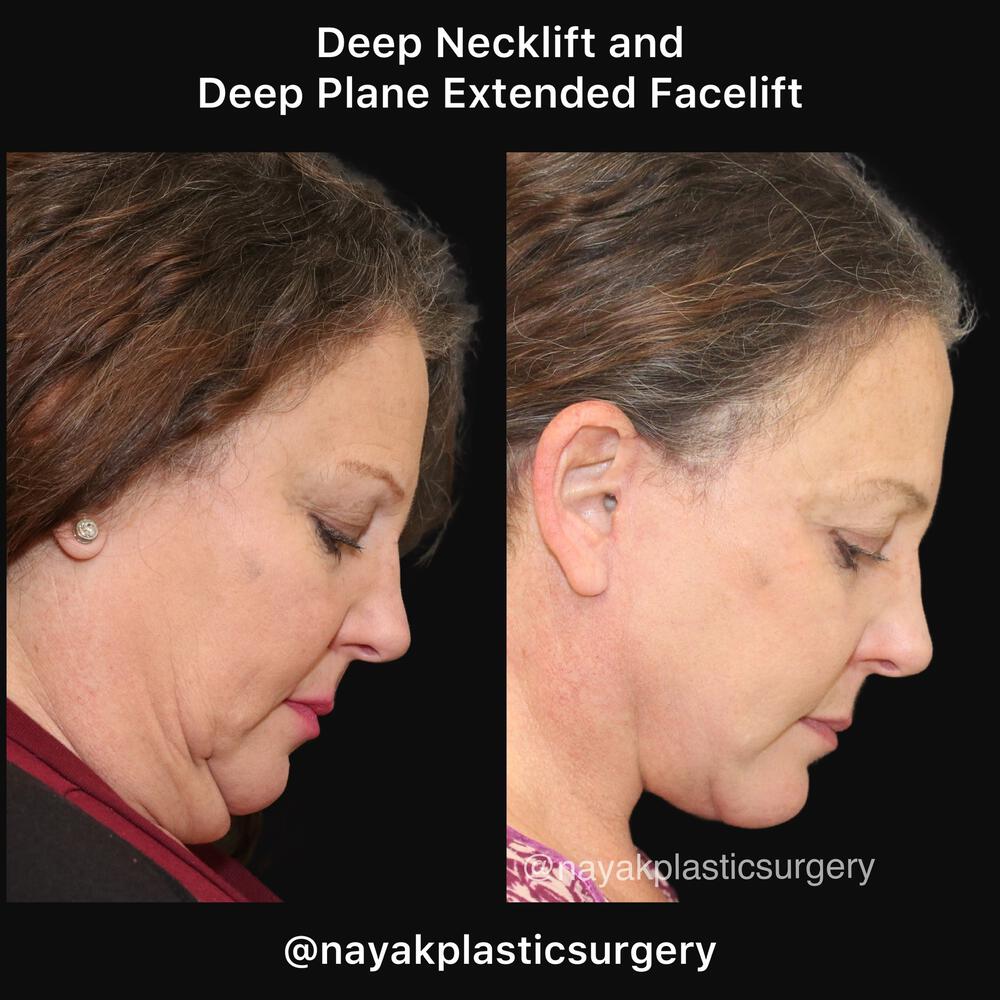 Deep Necklift Before & After Image