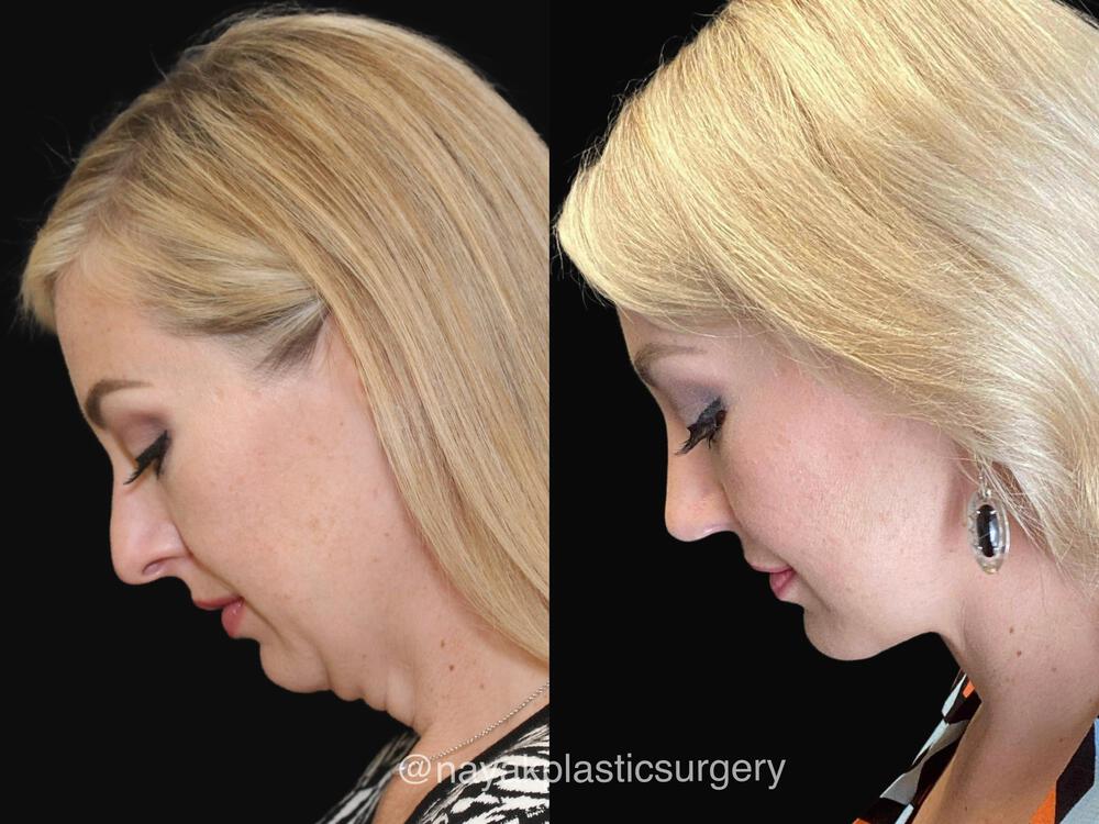 Deep Necklift Before & After Image