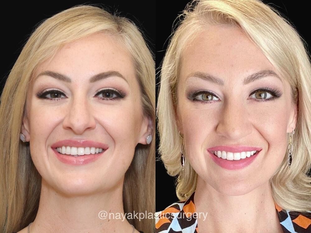 Deep Necklift Before & After Image