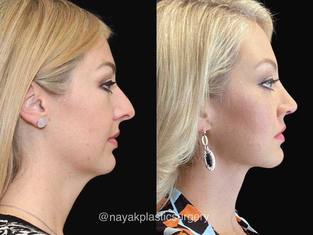 Deep Necklift Before & After Image