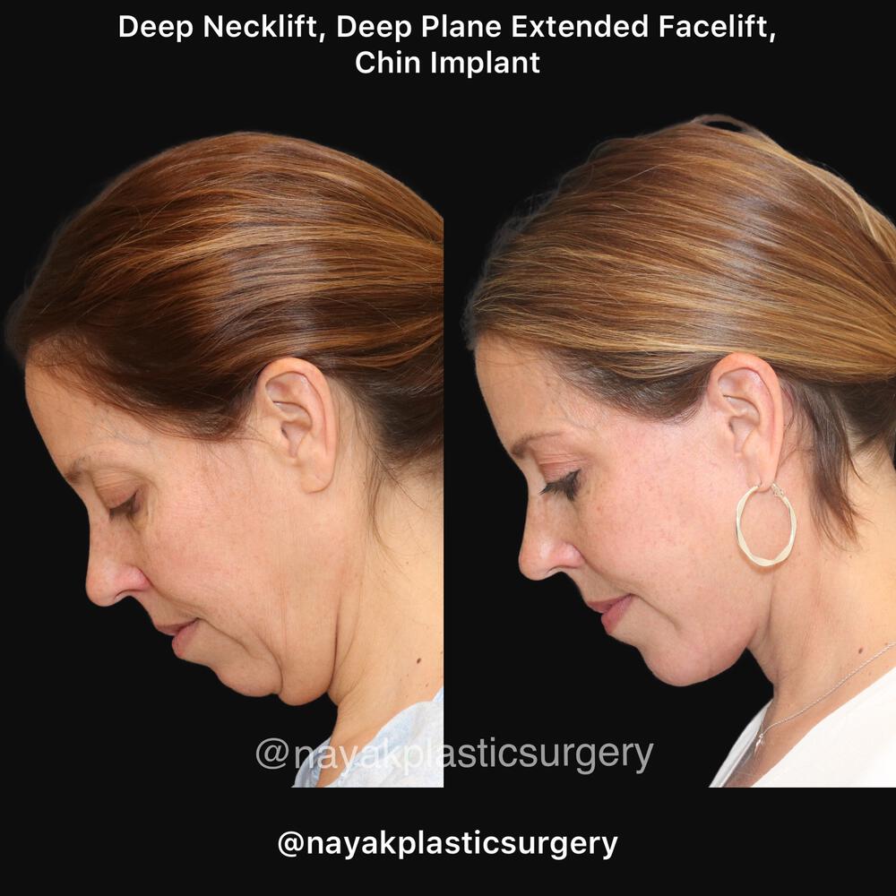 Deep Necklift Before & After Image