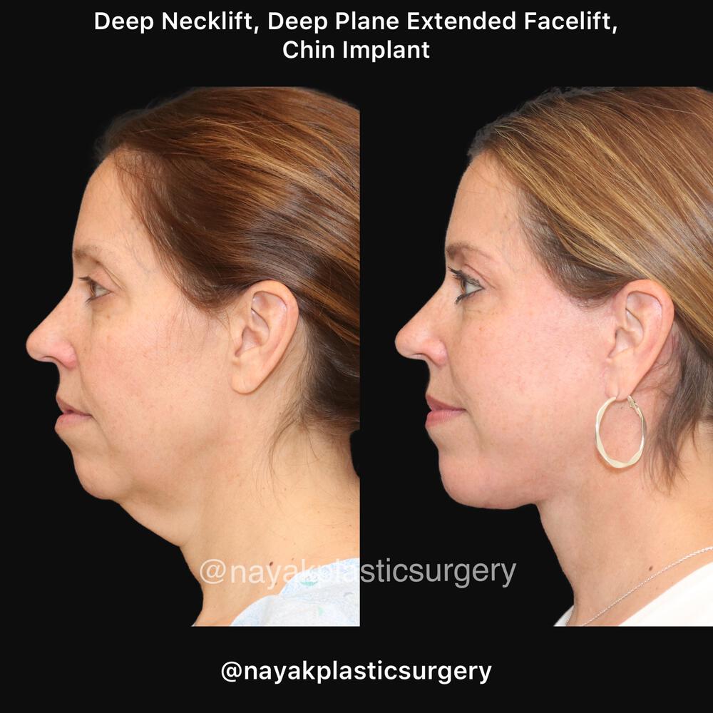 Deep Necklift Before & After Image