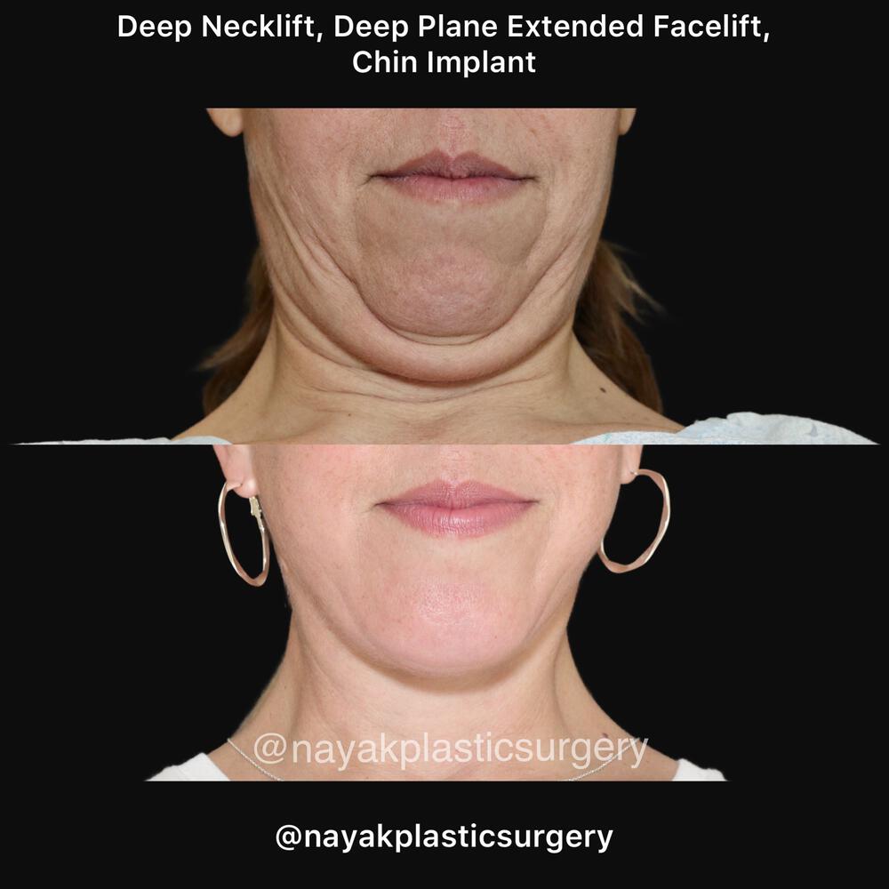 Deep Necklift Before & After Image