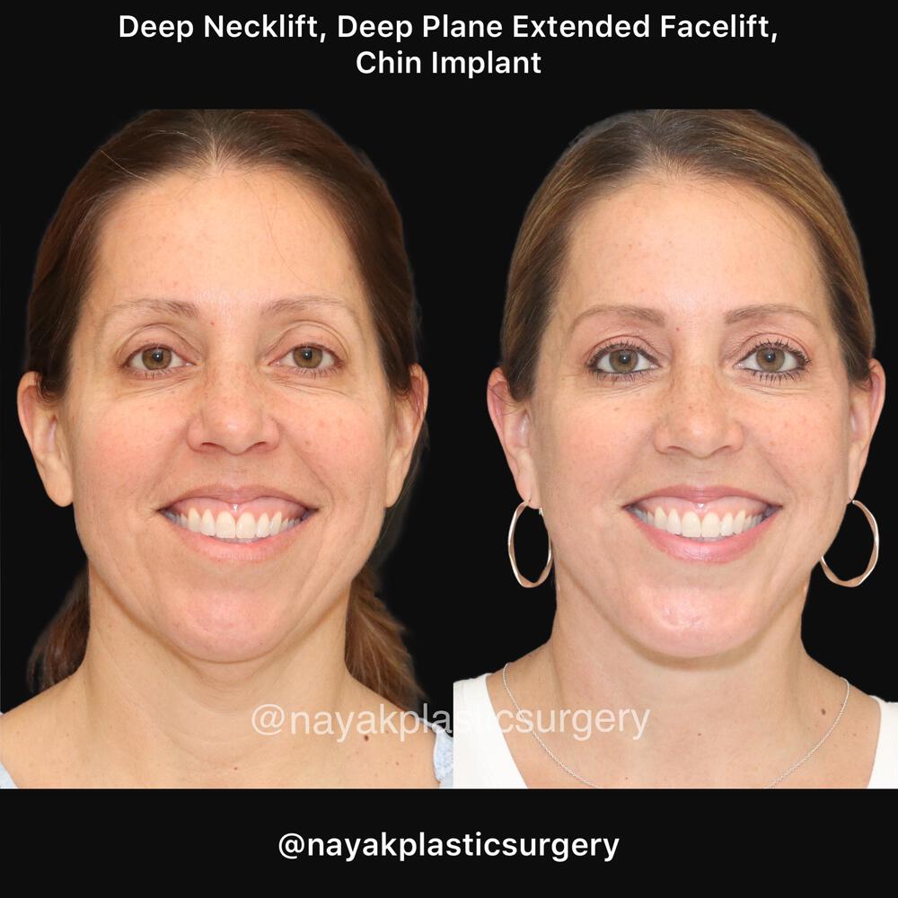 Deep Necklift Before & After Image