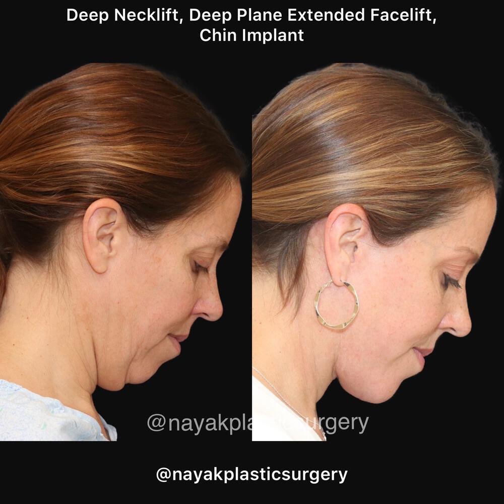 Deep Necklift Before & After Image