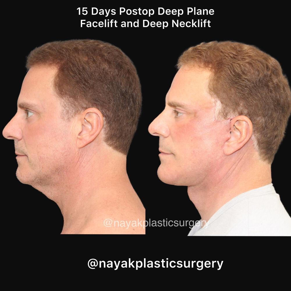 Deep Necklift Before & After Image