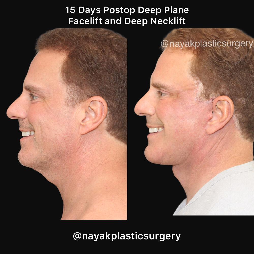 Deep Necklift Before & After Image