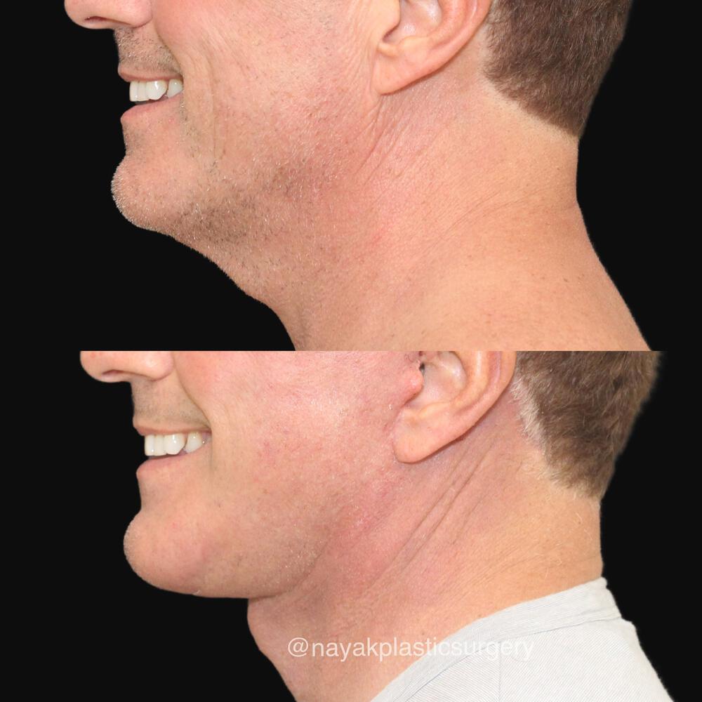 Deep Necklift Before & After Image