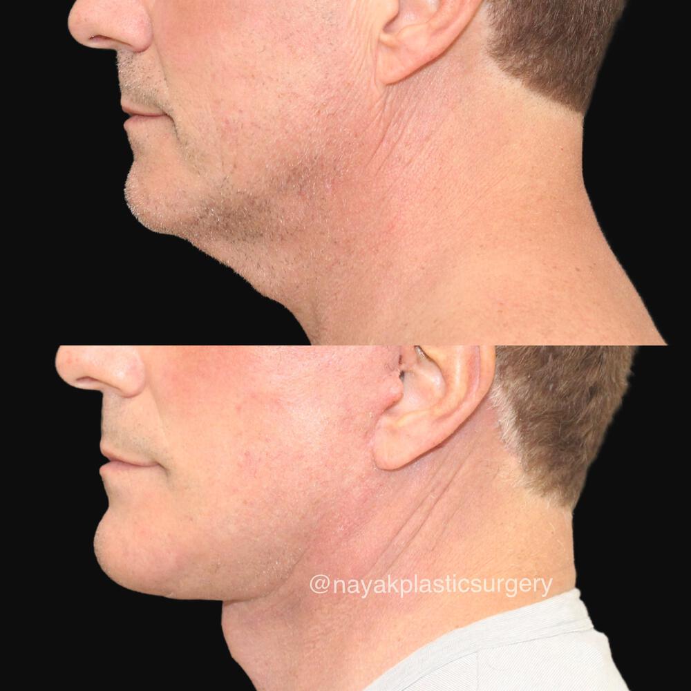 Deep Necklift Before & After Image