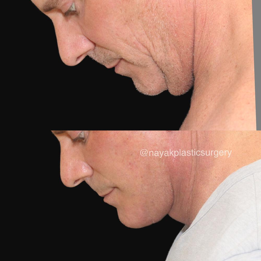 Deep Necklift Before & After Image