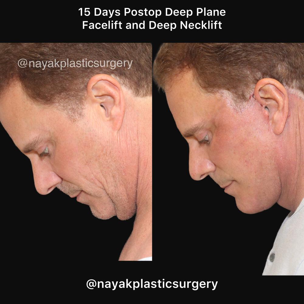 Deep Necklift Before & After Image