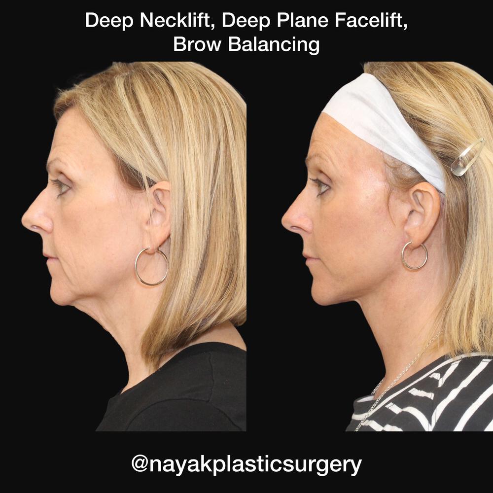 Deep Necklift Before & After Image