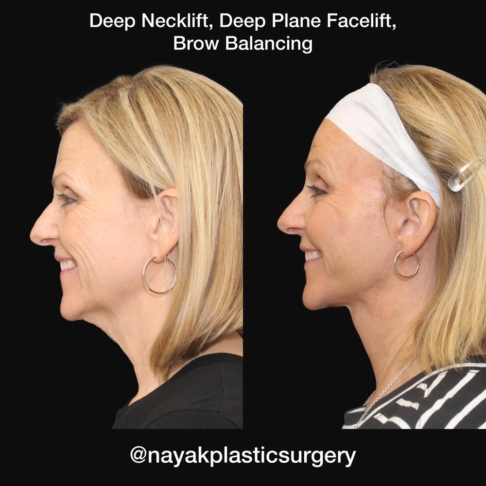 Deep Necklift Before & After Image